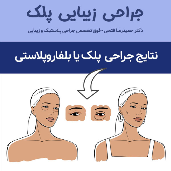 نتیجه جراحی زیبایی پلک 