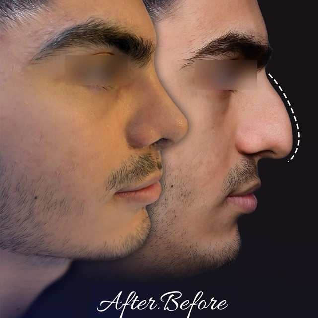 جراحی بینی نمونه کار