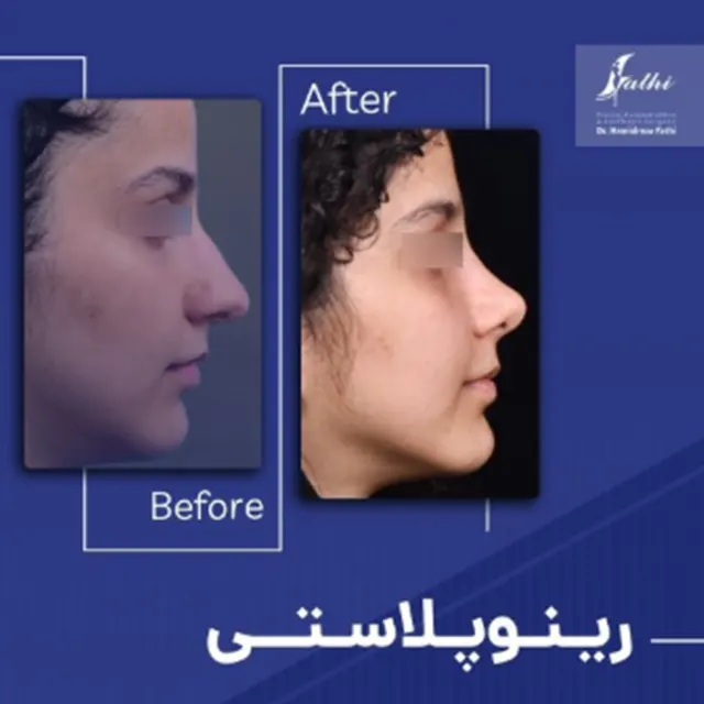 جراحی رینوپلاستی