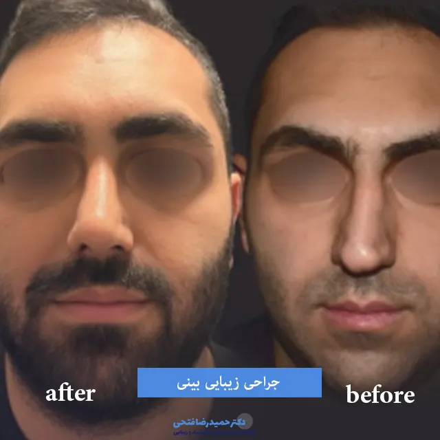 جراحی زیبایی بینی