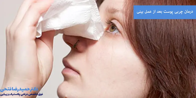 درمان چربی پوست بعد از عمل بینی