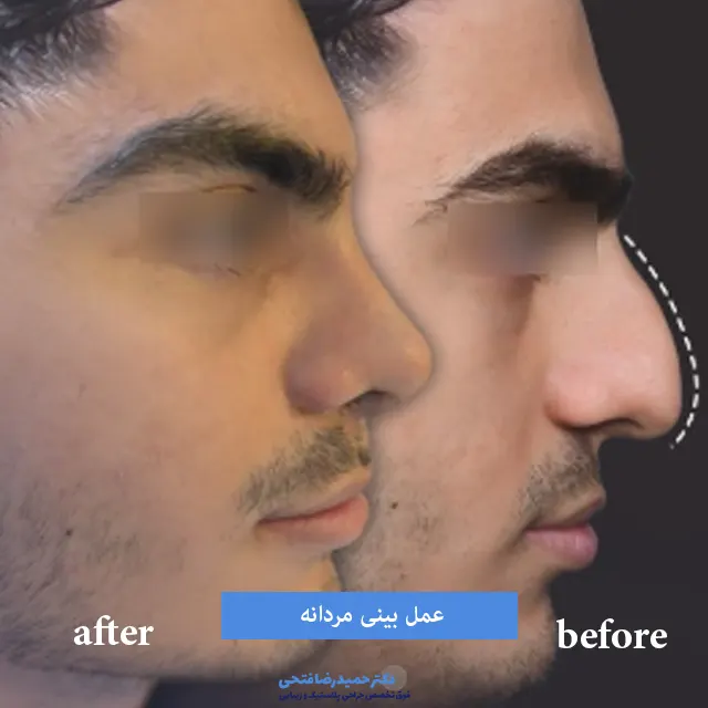 عمل بینی مردانه قبل و بعد