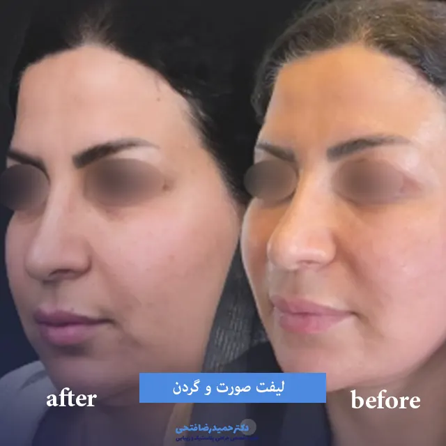 لیفت میانی صورت و گردن قبل و بعد