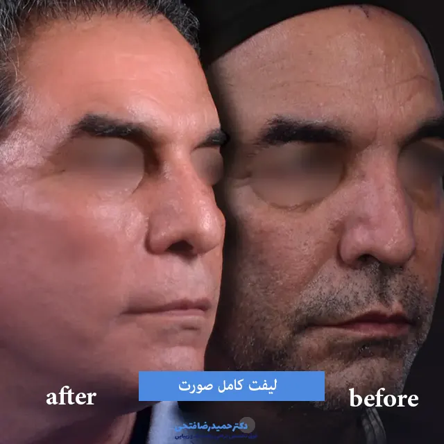 لیفت کامل صورت قبل و بعد