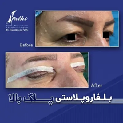 نمونه-کار-بلفاروپلاستی