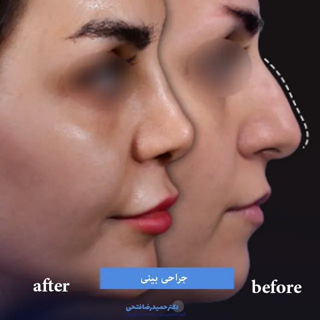 نمونه کار جراحی بینی قبل و بعد