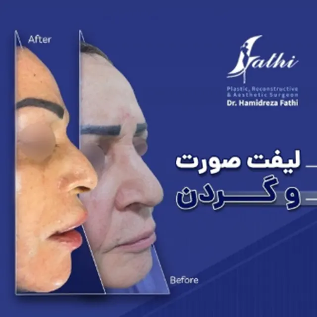 نمونه کار لیفت صورت و گردن