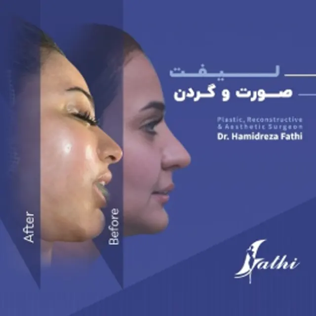 نمونه کار لیفت صورت