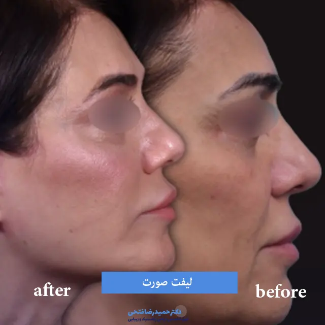 یکسال بعد از لیفت صورت قبل و بعد