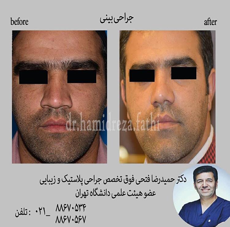 جراحی بینی مردانه