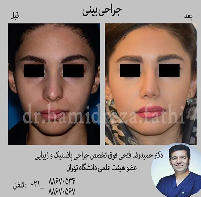 عمل بینی زنانه