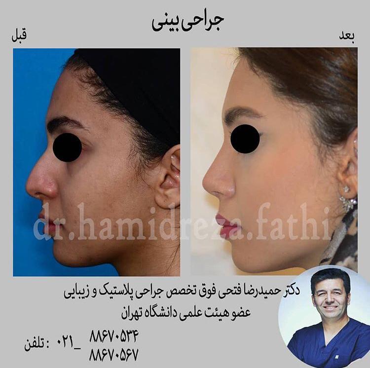 جراحی بینی با بهترین متخصص زیبایی در تهران