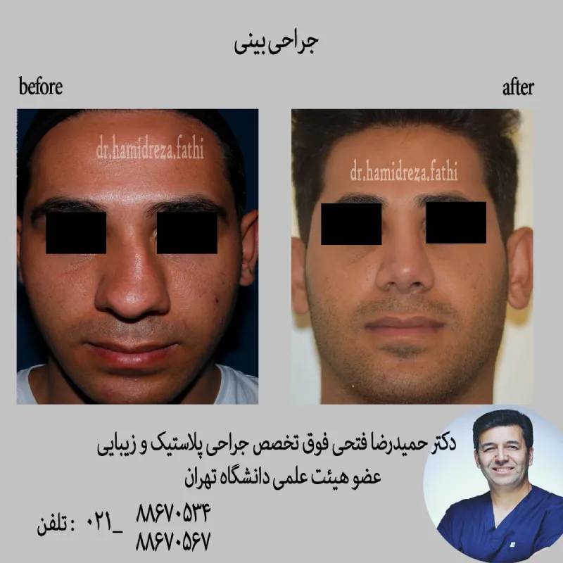 عمل بینی مردانه
