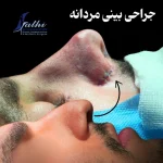 جراحی بینی مردانه