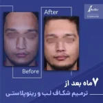 ترمیم شکاف لب