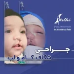 جراحی شکافلب و کام