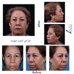 لیفت صورت نمونه کار کلی