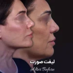 لیفت صورت نمونه کار