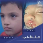 شکاف لب