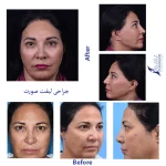 جراحی لیفت صورت دکتر فتحی