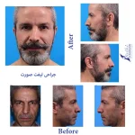 عمل لیفت صورت قبل و بعد از عمل