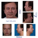 جراحی لیفت صورت نمونه کار دکتر حمیدرضا فتحی