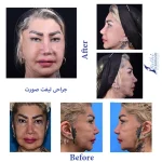 جراحی لیفت صورت نمونه کار دکتر فتحی قبل و بعد از عمل