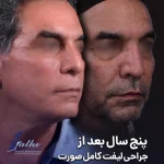 جراحی لیفت کامل صورت نمونه کار