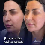 یک ماه بعد از لیفت صورت و گردن
