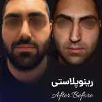 رینوپلاستی نمونه کار