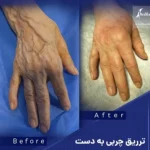 تزریق چربی به دست