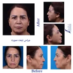نمونه کار جراحی لیفت صورت دکتر فتحی