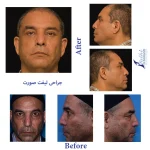 نمونه کار دکتر فتحی جراحی لیفت صورت