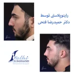 نمونه کار راینوپلاستی