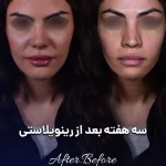 نمونه کار رینوپلاستی سه بعد از عمل