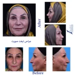 نمونه کار قبل و بعد از عمل لیفت صورت