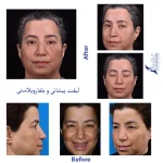 نمونه کار لیفت پیشانی و بلفاروپلاستی 2(کلی)
