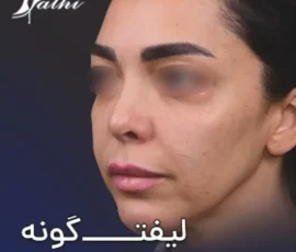 نمونه کار لیفت گونه بعد