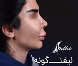 نمونه کار لیفت گونه