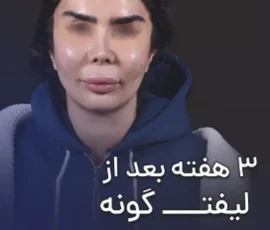 لیفت گونه