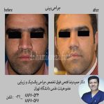جراحی بینی گوشتی جراحی بینی مردانه