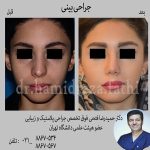 جراحی بینی گوشتی