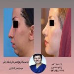 رینوپلاستی توسط فوق تخصص جراحی پلاستیک و زیبایی