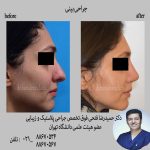 عمل زیبایی بینی