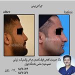جراحی بینی توسط فوق تخصص جراحی پلاستیک