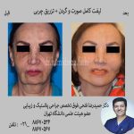 نمونه جراحی زیبایی توسط فوق تخصص جراحی پلاستیک دکتر فتحی