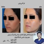رینوپلاستی