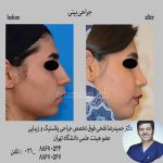 رینوپلاستی