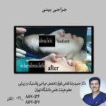 رینوپلاستی