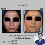 رینوپلاستی